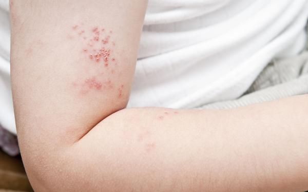 Zona, gordelroos, virale infectie, ouderen