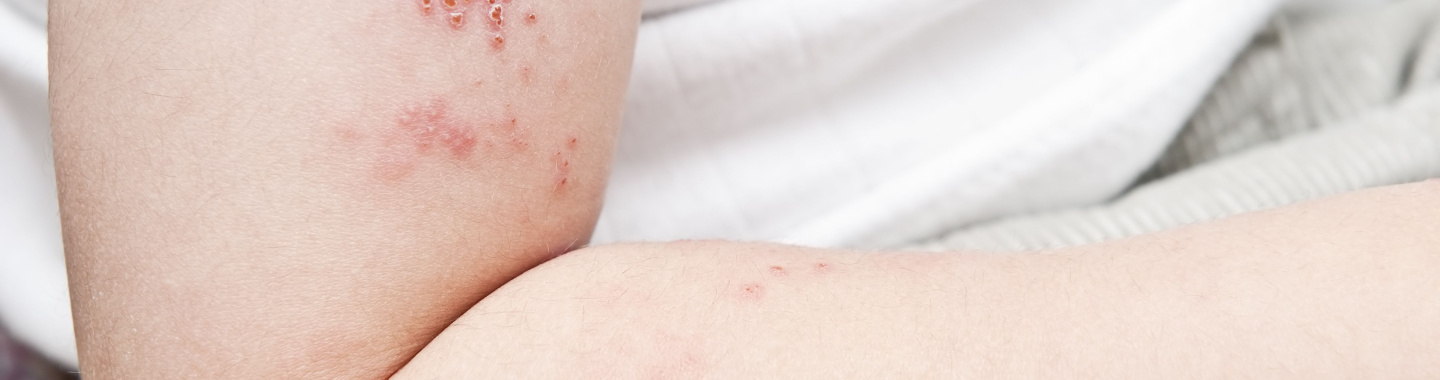 Zona, gordelroos, virale infectie, ouderen