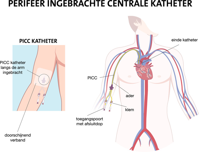Detailtekening van PICC-katheter